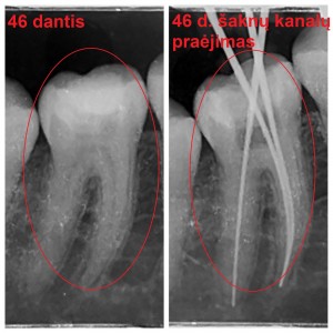 endodontinis gydymas